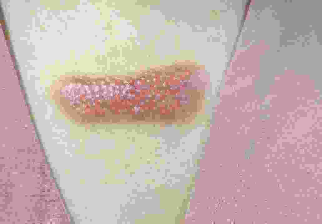 疤痕多久变软(增生疤痕变软是不是快好了)