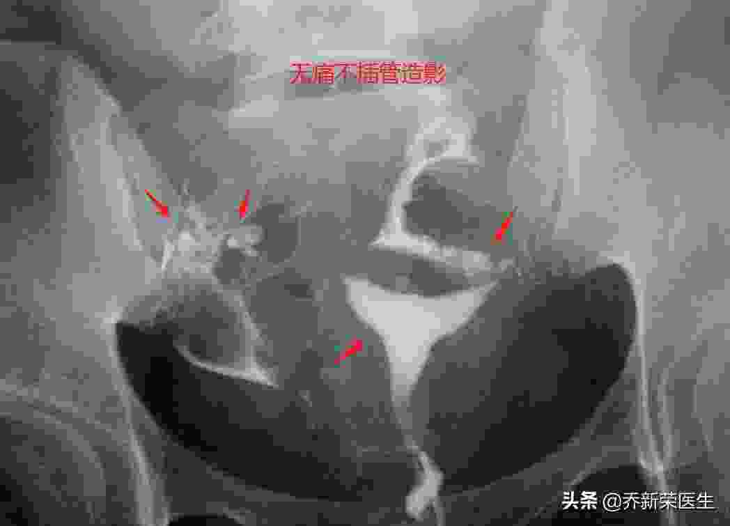 造影后多久可以要孩子(造影后3到6个月易受孕)