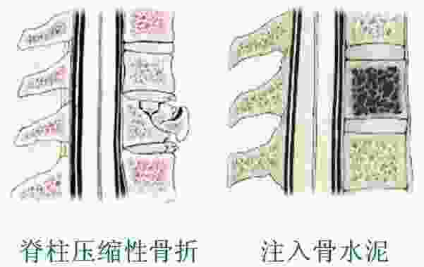 压缩性骨折一般躺多久(老人打骨水泥后期护理)