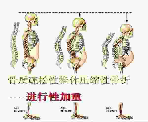 压缩性骨折一般躺多久(老人打骨水泥后期护理)