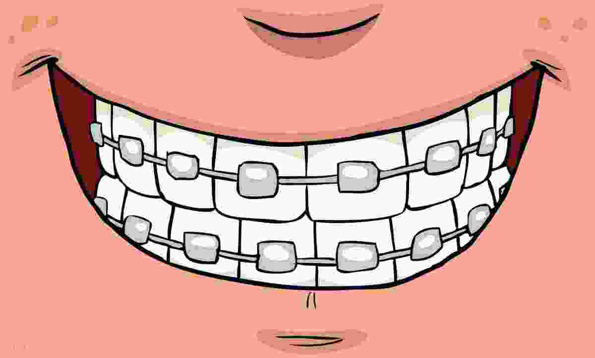 做牙齿要多久(牙齿垫高一般需要多久)