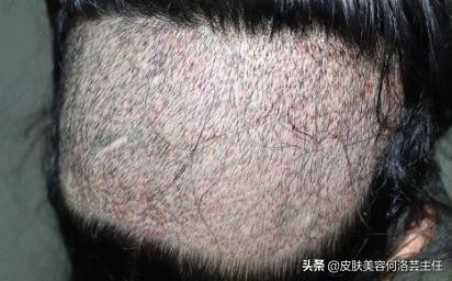 秃顶怎么办用什么能长起来