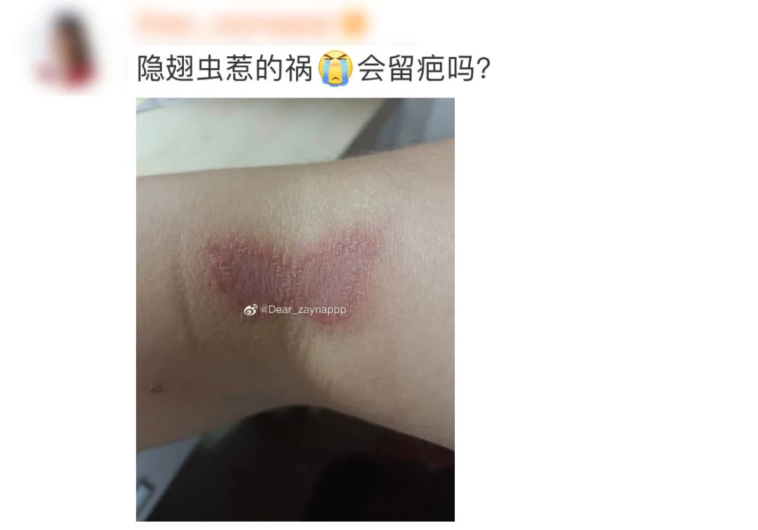 女人几乎毁容只是因为一只虫子