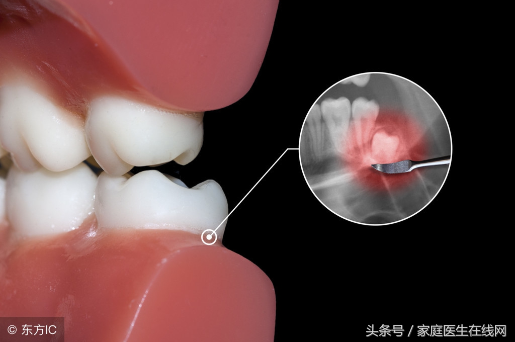 每个人都有智齿吗(为什么有些人会长智齿，长智齿会有什么影响)
