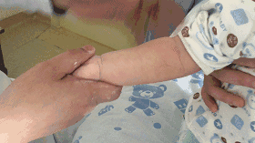 小儿高烧39度推拿手法图解（小儿高热退烧推拿手法）