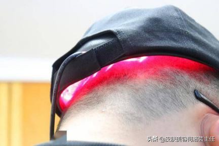 秃顶怎么办用什么能长起来