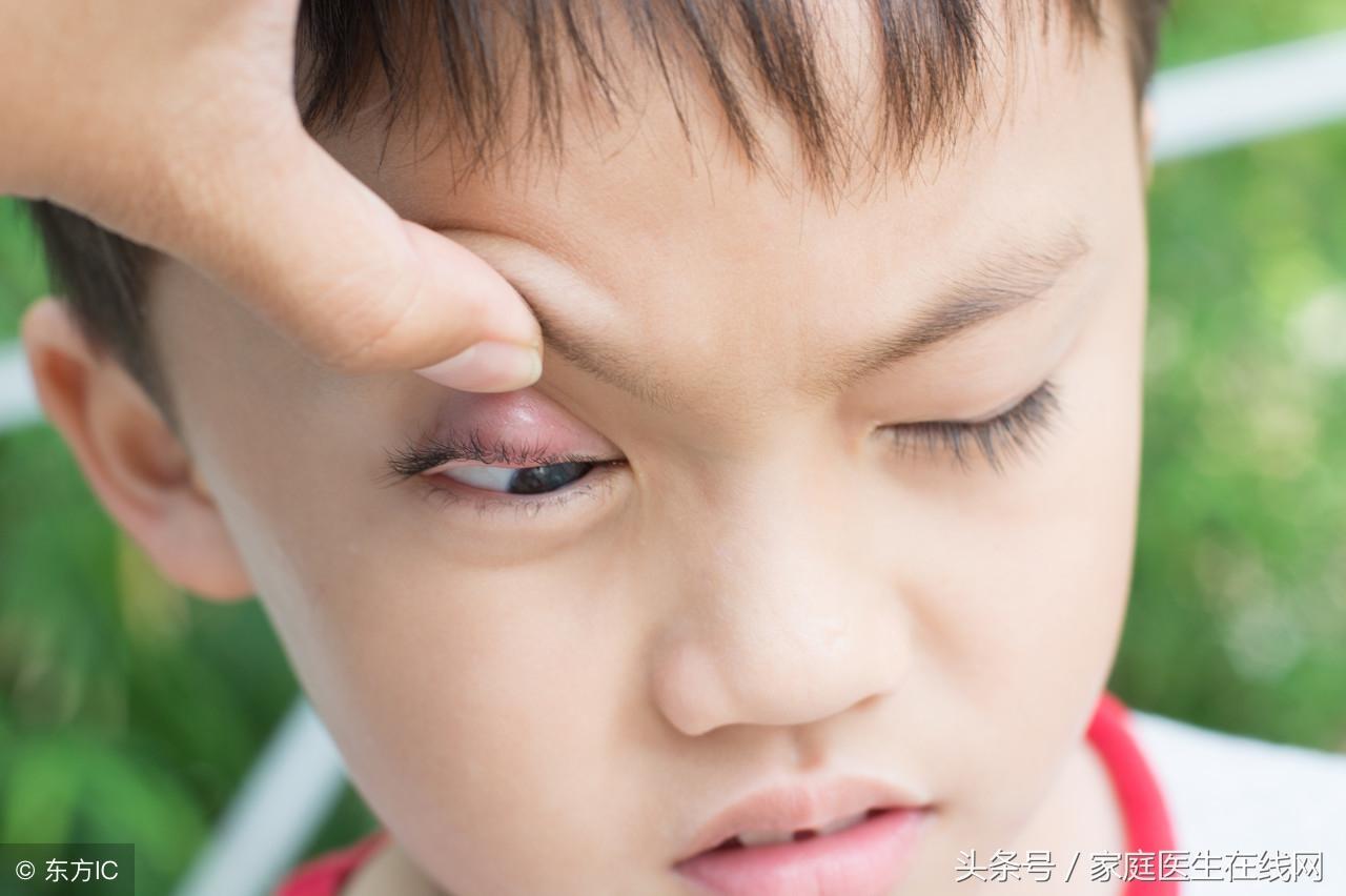 麦粒肿留下硬结一年多了怎么办(麦粒肿有硬结怎么办)