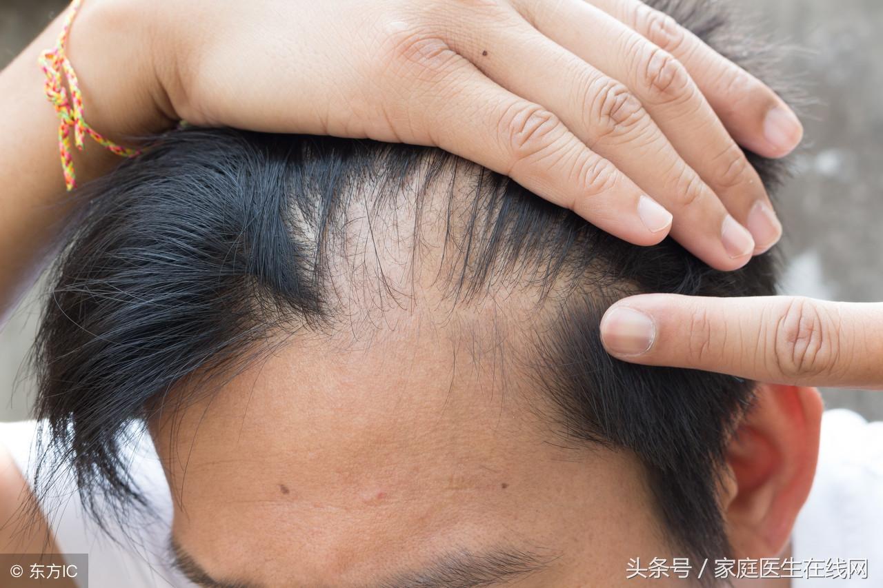 脱发严重是什么原因引起的 为什么头发总是一大把的掉？