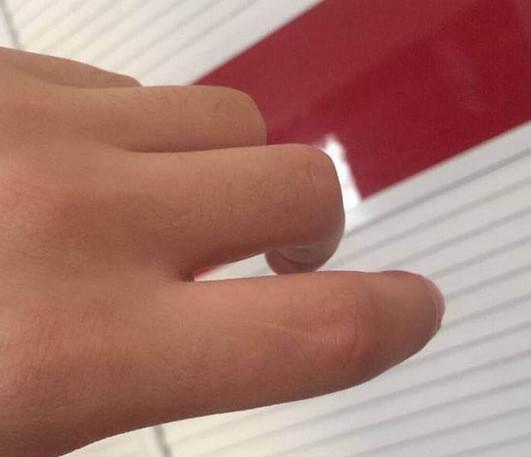 为什么每个人的左手食指有一个疤（你的左手食指有一道疤吗）